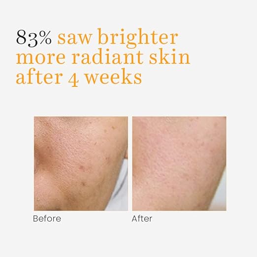 O3+ Vitamin C Serum Glow- Face & Neck Serum- Combination Skin-30ml