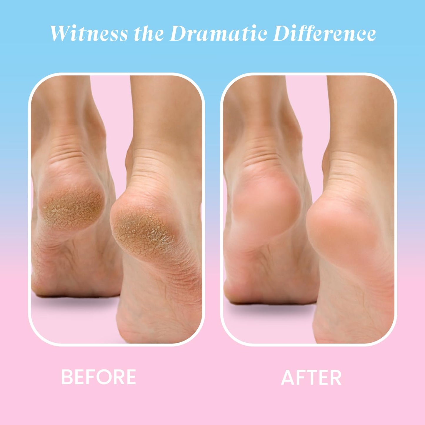Urban Yog Callus Remover, Foot Scrubber For Dead Skin, With 3 Interchangeable Head Rollers, Rechargeable, Callus & Dead Skin Removal, 2 Speed Settings, Fast Type-C Charging, 1200mAh Battery