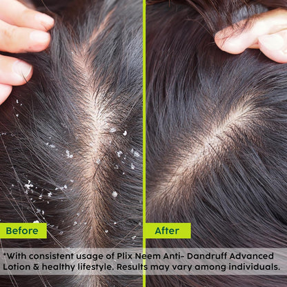 Plix Neem Anti-Dandruff Advanced Lotion | Reduce Dandruff, Itching & Irritation | With Dandelix Pro & Ichthyol PALE | Paraben & Sulphate Free, (60ml)